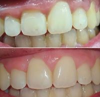 Gingivoplastia Terrassa