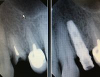 Implante dental Terrassa