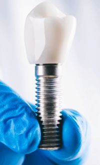 Implantes en Terrassa